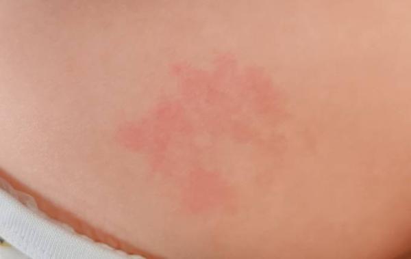 Bild zu Feuermal Pigmentstörhng oder doch was anderes ? - Baby Forum - Allgemeine Themen