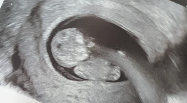 Bild zu Zu großer Kopf? - Baby Forum - Allgemeine Themen