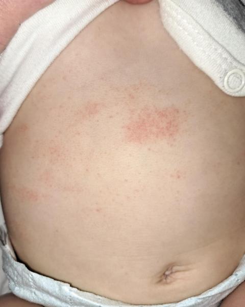 Bild zu Rote Flecken, frieseln, Flecken mir pickeln? - Baby Forum - Allgemeine Themen