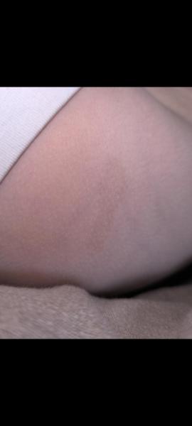 Bild zu Cafe au lait Flecken Dr. Abeck - Baby Forum - Allgemeine Themen