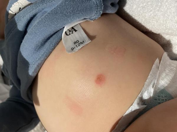 Bild zu Offene komische Haut stellen bei 8 Monate alten Baby - Baby Forum - Allgemeine Themen