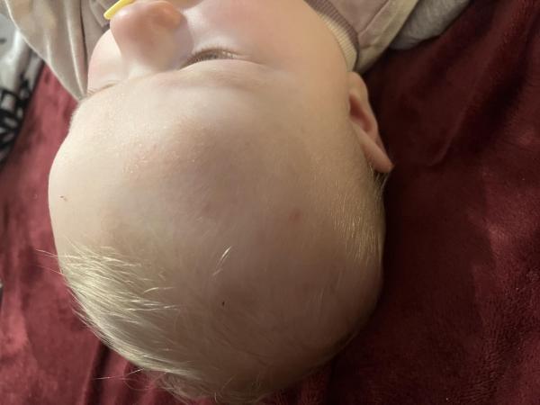 Bild zu Könnten das Windpocken sein? - Baby Forum - Allgemeine Themen