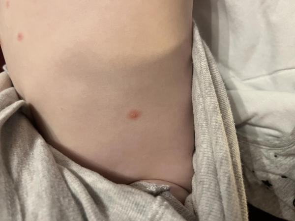 Bild zu Könnten das Windpocken sein? - Baby Forum - Allgemeine Themen