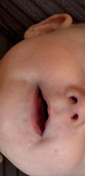 Bild zu Ausschlag im Gesicht - Baby Forum - Allgemeine Themen