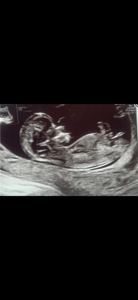 Bild zu Nub Mädchen oder Junge? - Baby Forum - Allgemeine Themen