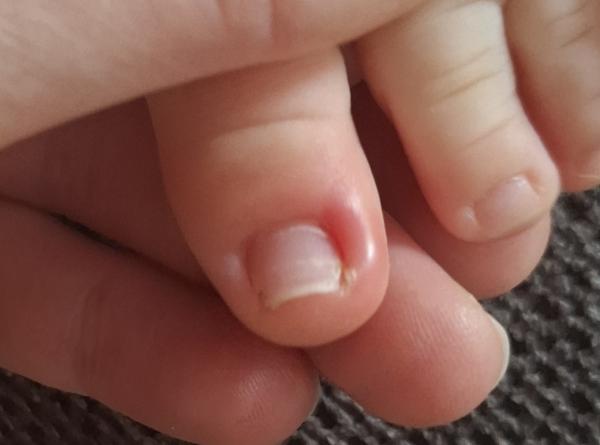 Bild zu Ständig nagelbettentzündung - Baby Forum - Allgemeine Themen