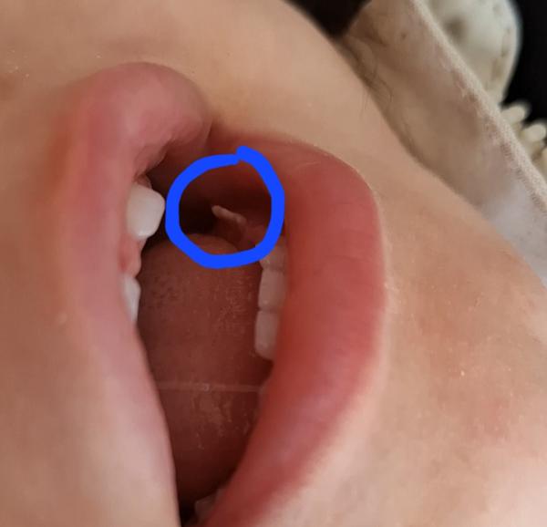 Bild zu Kleinkind 13 Monate Apthe? - Baby Forum - Allgemeine Themen