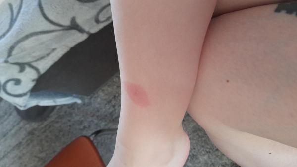 Bild zu Insektenstich, was ist das ? - Baby Forum - Allgemeine Themen
