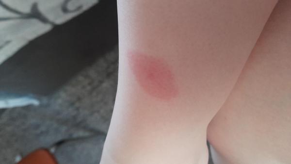 Bild zu Insektenstich, was ist das ? - Baby Forum - Allgemeine Themen