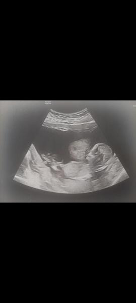 Bild zu Nub-Theorie Junge oder Mädchen - kennt sich wer aus? - Baby Forum - Allgemeine Themen