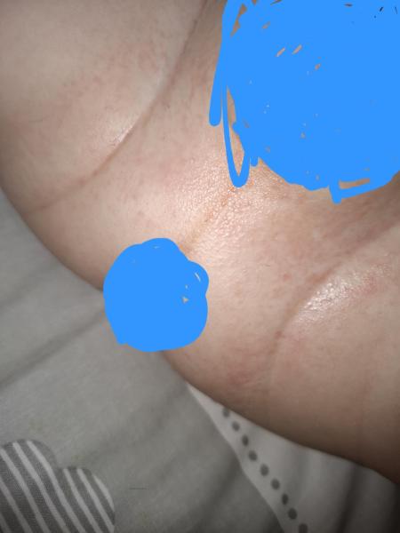 Bild zu Ausschlag, windeldermatitis was ist das? - Baby Forum - Allgemeine Themen