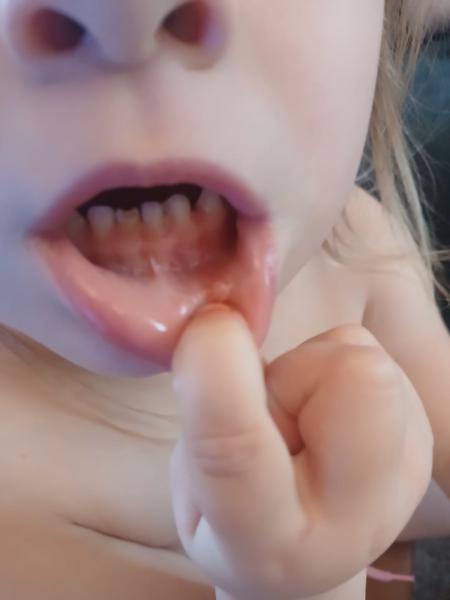 Bild zu Meine Tochter hat seit 1 Woche weisse Knubbel an der Innenlippen - Baby Forum - Allgemeine Themen