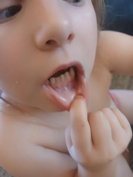 Bild zu Meine Tochter hat seit 1 Woche weisse Knubbel an der Innenlippen - Baby Forum - Allgemeine Themen