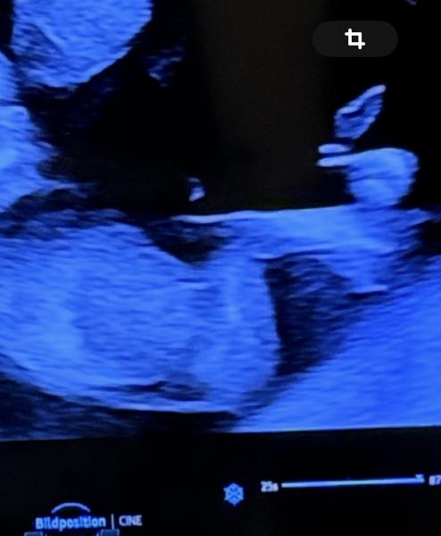 Bild zu Geschlecht deuten? Mädchen oder Junge?🤭 - Baby Forum - Allgemeine Themen