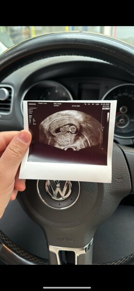 Bild zu Was dengt ihr ist es ein Mädchen oder ein Junge - Kuhmilchallergie – Rund ums Baby Elternforum