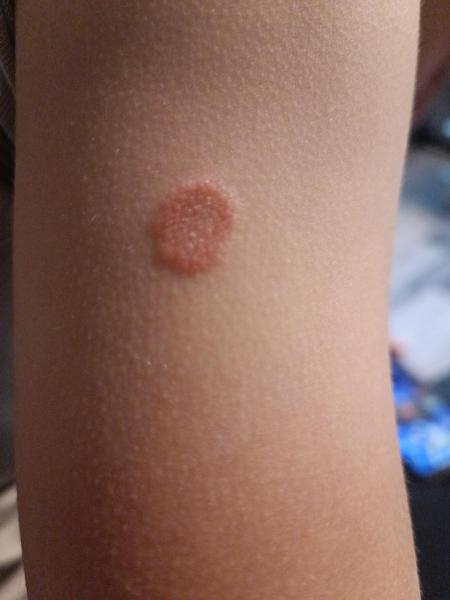 Bild zu Was könnte das sein ? - Allergien – Rund ums Baby Elternforum