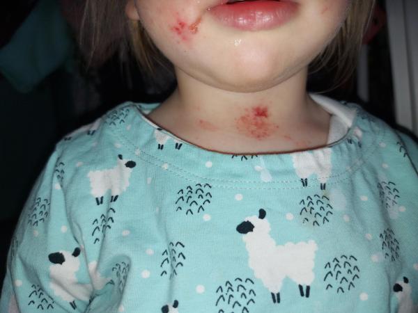 Bild zu Neurodermitis Verschlimmerung nach Infekten - Haut von Babys und Kindern ✔️ Expertenforum