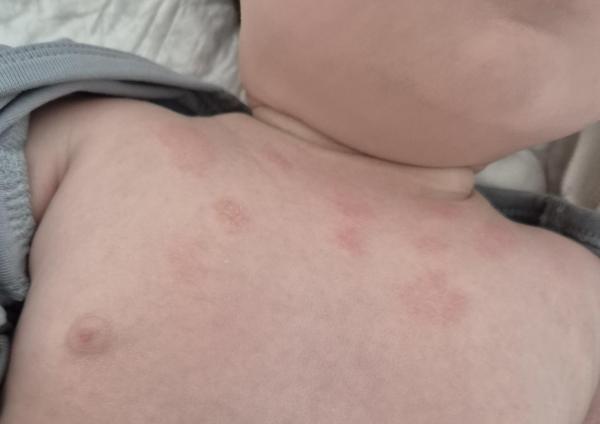 Bild zu Hautausschlag Dekolleté - Haut von Babys und Kindern ✔️ Expertenforum