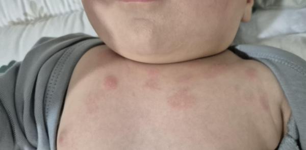 Bild zu Hautausschlag Dekolleté - Haut von Babys und Kindern ✔️ Expertenforum
