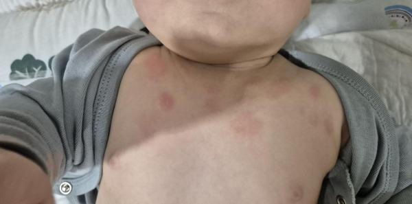 Bild zu Hautausschlag Dekolleté - Haut von Babys und Kindern ✔️ Expertenforum