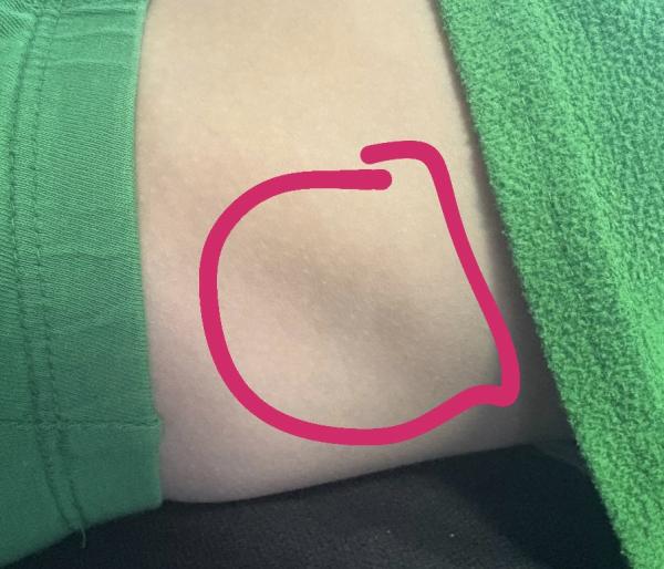 Bild zu Brauner Fleck / und rote Stelle - Haut von Babys und Kindern ✔️ Expertenforum