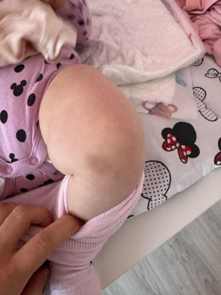 Bild zu Blaue flecken - Haut von Babys und Kindern ✔️ Expertenforum