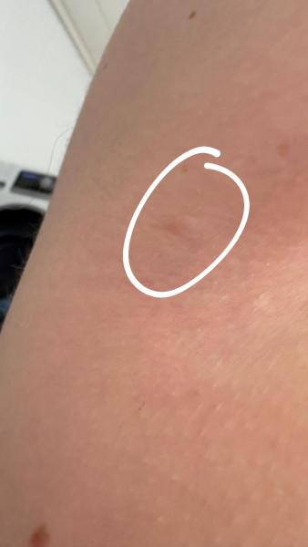 Bild zu Fett Knubbel ? - Haut von Babys und Kindern ✔️ Expertenforum