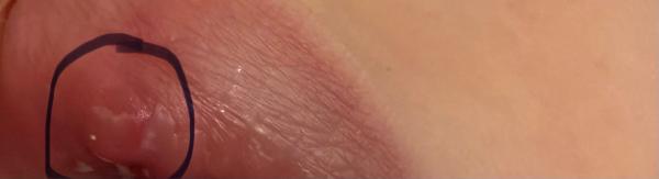 Bild zu Kind auf Lippe gestürzt Wulst - Haut von Babys und Kindern ✔️ Expertenforum