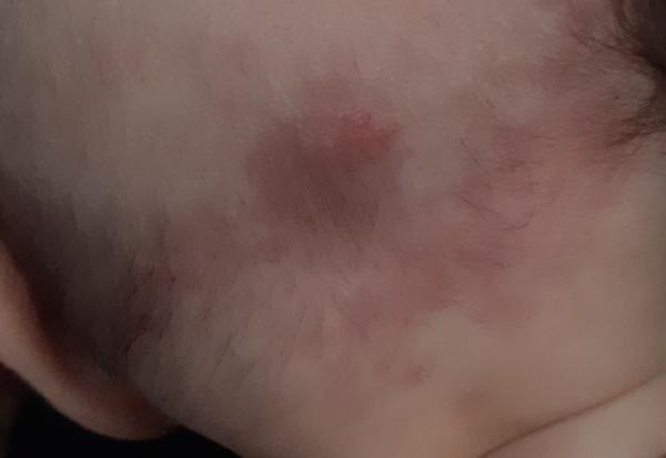 Bild zu Ekzem Hinterkopf - Haut von Babys und Kindern ✔️ Expertenforum