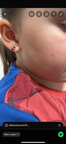 Bild zu Hautpilz - Haut von Babys und Kindern ✔️ Expertenforum