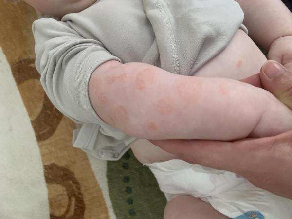 Bild zu Nummuläre Form des atopischen Ekzem - Haut von Babys und Kindern ✔️ Expertenforum