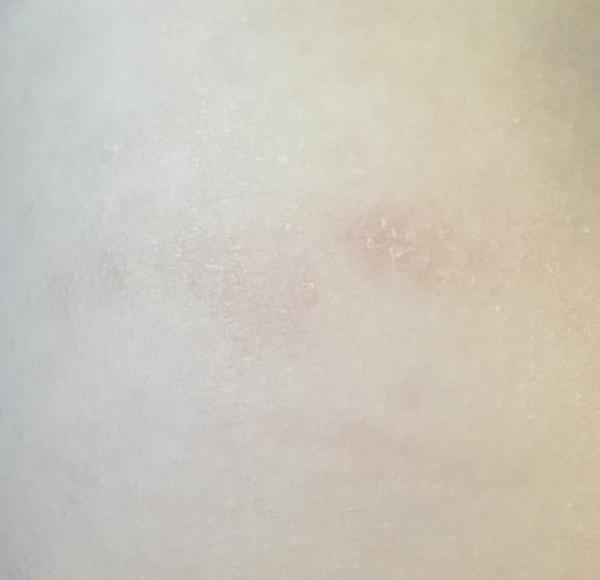 Bild zu Brauner Fleck / und rote Stelle - Haut von Babys und Kindern ✔️ Expertenforum