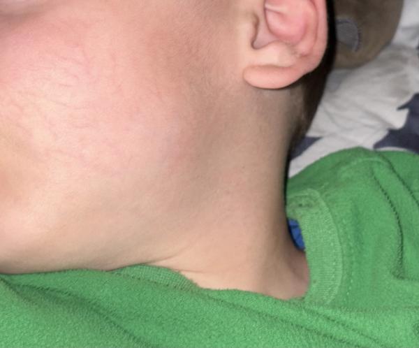 Bild zu Wange Äderchen - Haut von Babys und Kindern ✔️ Expertenforum