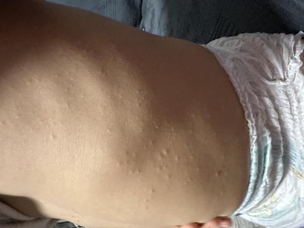 Bild zu Hautprobleme 3.5 Jahre Sohn - Haut von Babys und Kindern ✔️ Expertenforum