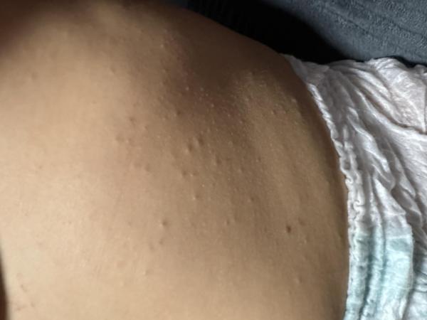 Bild zu Hautprobleme 3.5 Jahre Sohn - Haut von Babys und Kindern ✔️ Expertenforum
