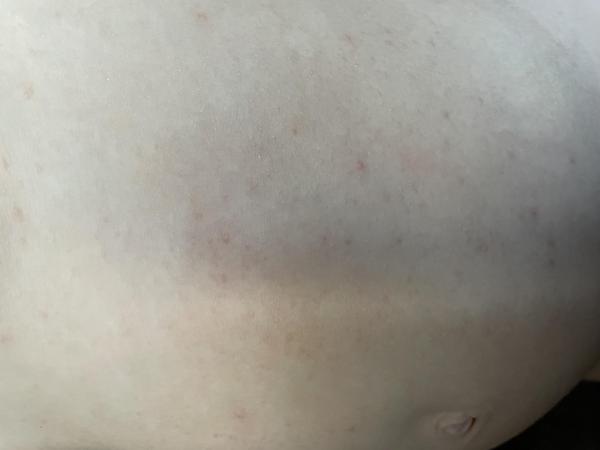 Bild zu Kleine Pickel-Neurodermitis? - Haut von Babys und Kindern ✔️ Expertenforum