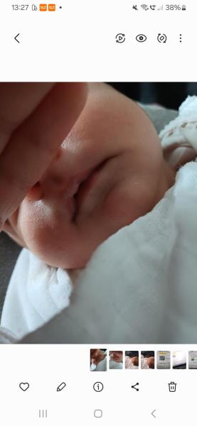 Bild zu Saugbläschen? - Haut von Babys und Kindern ✔️ Expertenforum