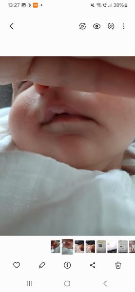 Bild zu Saugbläschen? - Haut von Babys und Kindern ✔️ Expertenforum