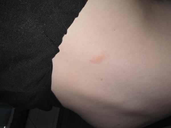 Bild zu Fleck auf dem Rücken bei 8 jährigen Mädchen - Haut von Babys und Kindern ✔️ Expertenforum