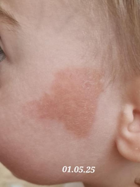 Bild zu Rote Flecken im Gesicht Kinderarzt hat keine Diagnose - Haut von Babys und Kindern ✔️ Expertenforum