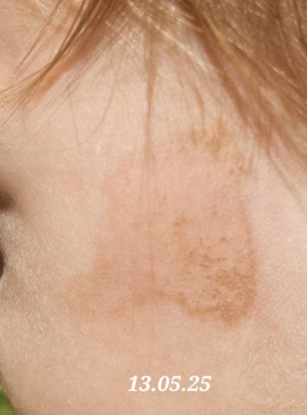 Bild zu Rote Flecken im Gesicht Kinderarzt hat keine Diagnose - Haut von Babys und Kindern ✔️ Expertenforum