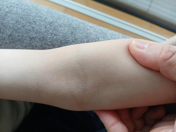 Bild zu Woher rauhe Haut? - Haut von Babys und Kindern ✔️ Expertenforum