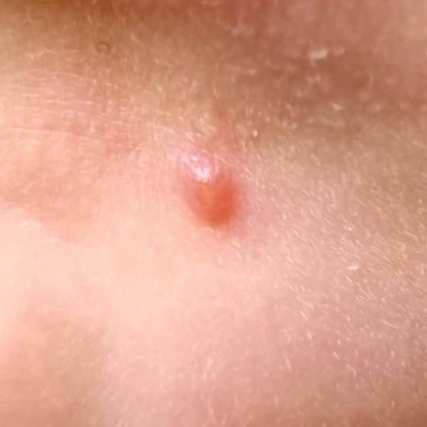 Bild zu Pickel am Kinn - Haut von Babys und Kindern ✔️ Expertenforum
