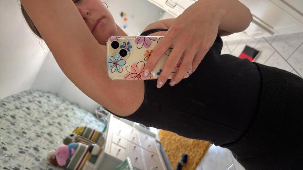 Bild zu Ekzem/Neurodermitis Achsel - Haut von Babys und Kindern ✔️ Expertenforum