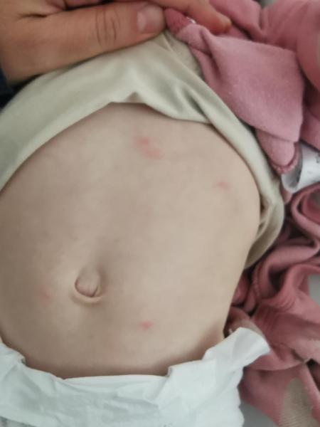 Bild zu Rote Pünktchen, 1 Jæhriges Mædchen - Haut von Babys und Kindern ✔️ Expertenforum