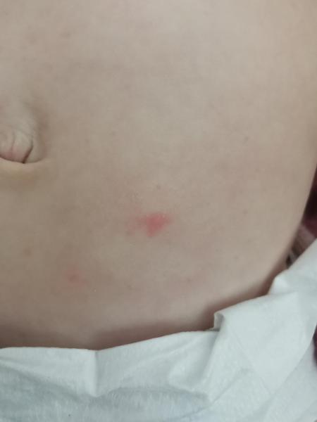 Bild zu Rote Pünktchen, 1 Jæhriges Mædchen - Haut von Babys und Kindern ✔️ Expertenforum