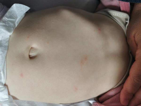 Bild zu Rote Pünktchen, 1 Jæhriges Mædchen - Haut von Babys und Kindern ✔️ Expertenforum