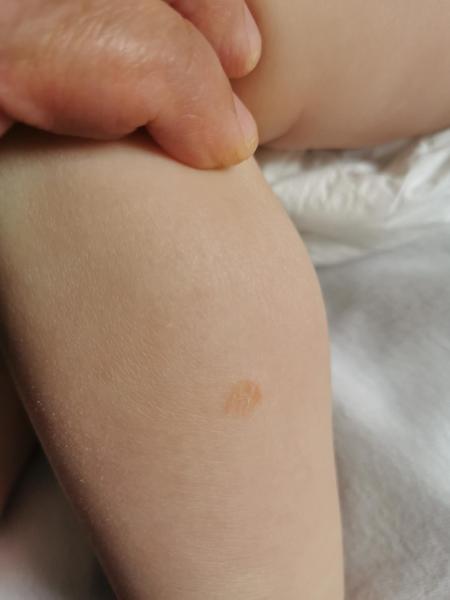 Bild zu Rote Pünktchen, 1 Jæhriges Mædchen - Haut von Babys und Kindern ✔️ Expertenforum