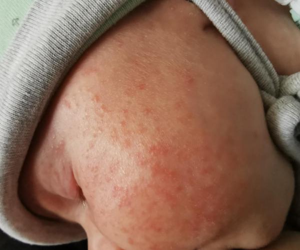 Bild zu Neugeborenen Akne? Was anderes? - Haut von Babys und Kindern ✔️ Expertenforum
