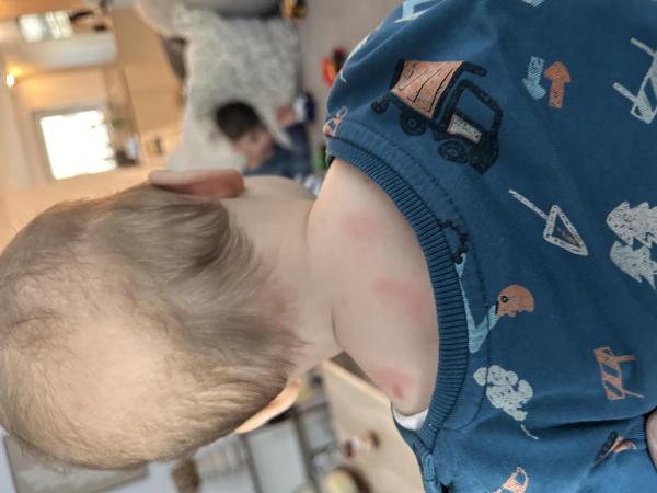 Bild zu Mastozytose - Haut von Babys und Kindern ✔️ Expertenforum